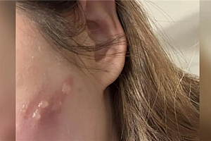 女生玩手机睡着:iPhone贴在脸上直接烫出4颗大水泡!