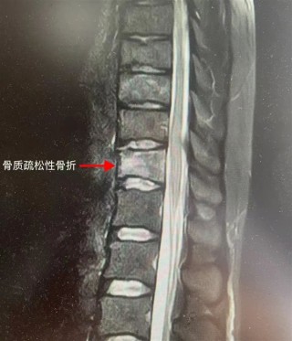 每日四杯咖啡导致年轻女子骨质疏松，弯腰即骨折警告